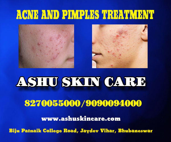 best acne and pimples treatment clinic in bhubaneswar close to aiims hospital